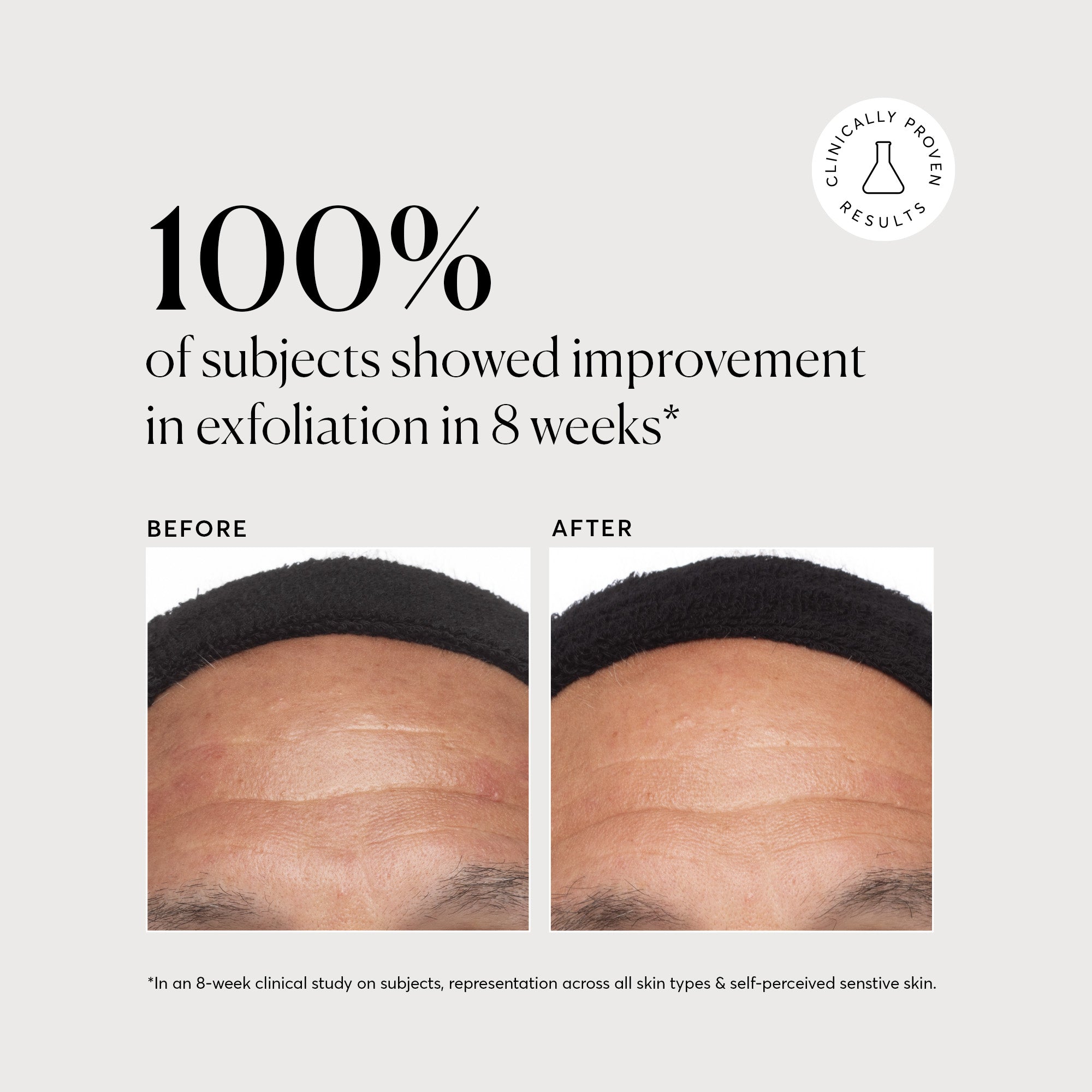 NATR_Azelaic_Acid_Clinical_B_A_Exfoliation_Graphic_1.1_Bone_857bb1ce-0093-44b1-b82b-086caf9471aa